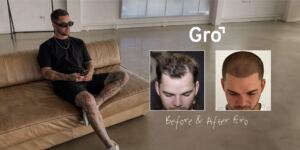 Gro Clinics Celebrates Over 26 Million Hairs Transplanted Across Australia and New Zealand