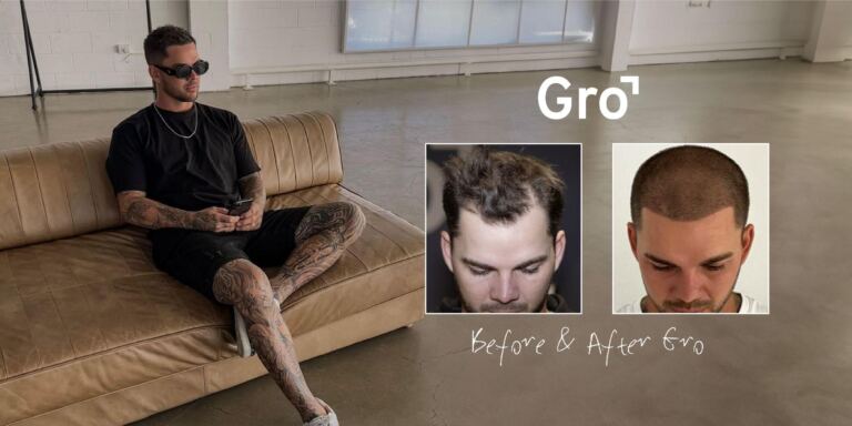 Gro Clinics Celebrates Over 26 Million Hairs Transplanted Across Australia and New Zealand